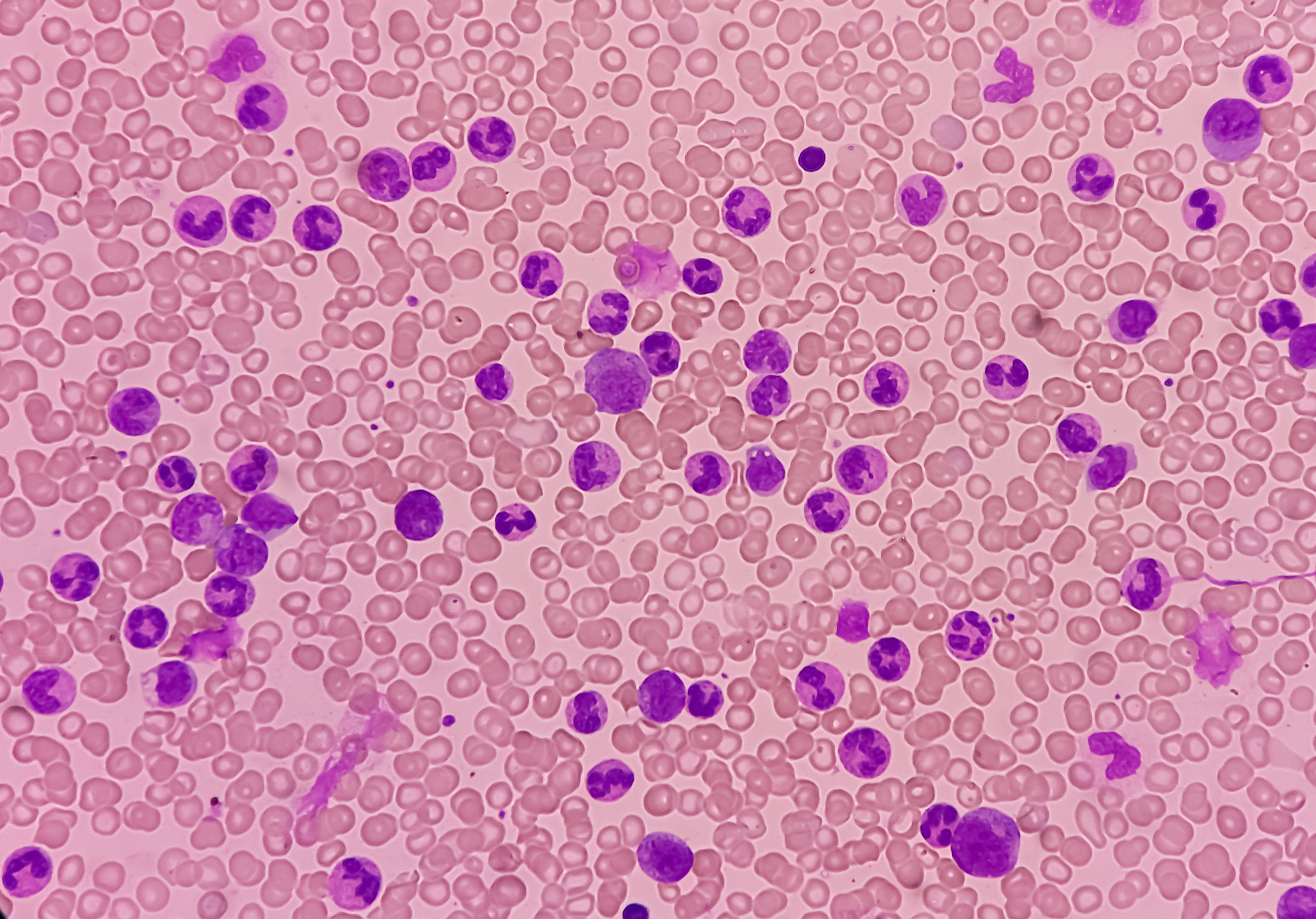 Blood cancer. Chronic myeloid leukemia(CML) with Thrombocytopenia. Chronic myelogenous leukemia.